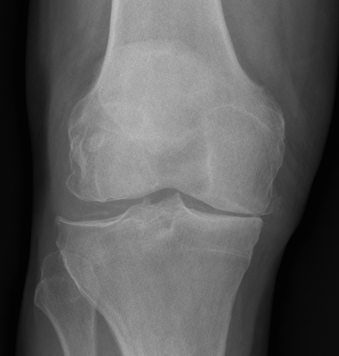 Knee Chondrocalcinosis Xray